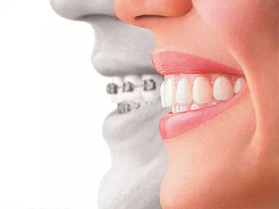 Invisalign® vs Braces