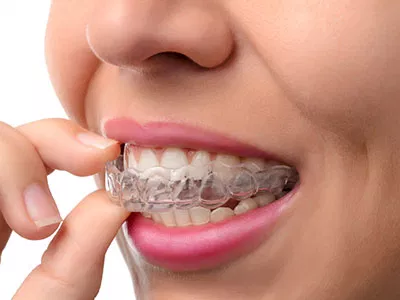 Invisalign® vs Direct-To-Consumer Aligners