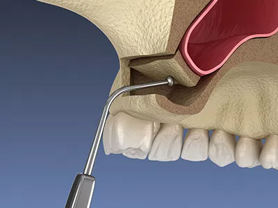 sinus lift